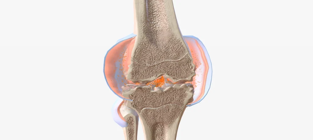Bone Marrow Transplant